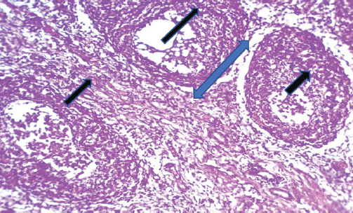 A novel reassortant strain of the infectious bursal disease virus (IBDV ASPVB) from Iraqi broiler farms: A first-time molecular and histopathological investigation revealing new insights.