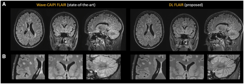 Physics-informed deep learning reconstruction for ultrafast clinical 3D fluid-attenuated inversion recovery brain MRI.