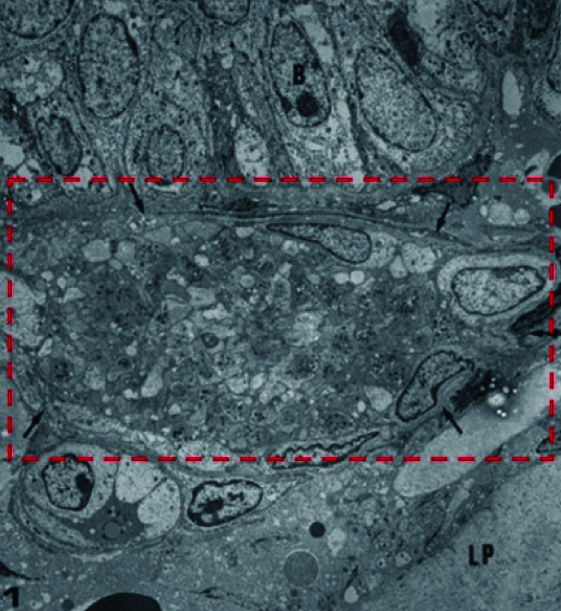 The advancements in understanding the pathogenesis of ear fullness.
