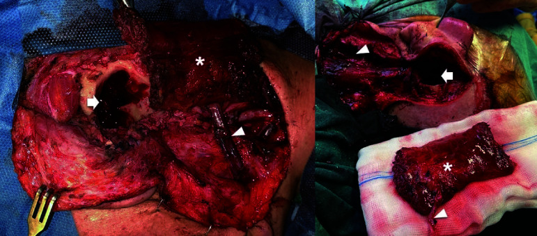 Novel Approach to Osteoradionecrosis of the Temporal Bone: Vascularized Obliteration with Gracilis Muscular Free Flap.