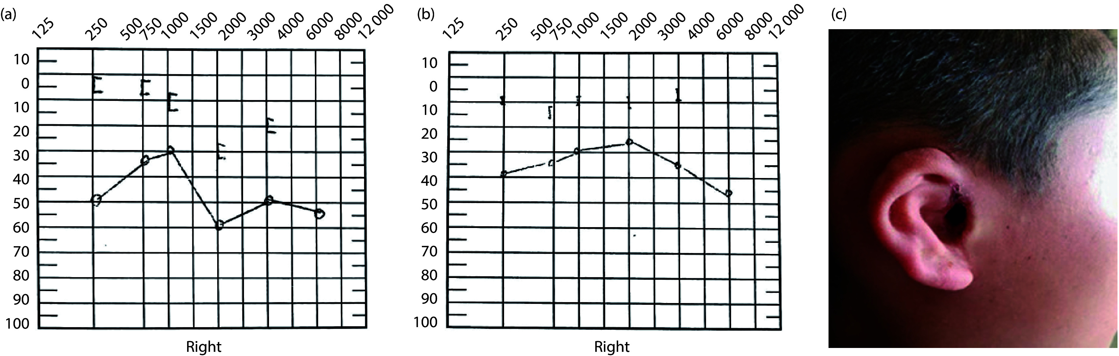 Case report of a novel <i>GREB1L</i> gene mutation in a patient with branchio-oto-renal syndrome.
