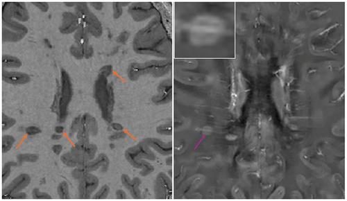 T1-Dark Rim as a Marker of New and Chronic Active Multiple Sclerosis Lesions: A Serial Study With Frequent 7T MRI