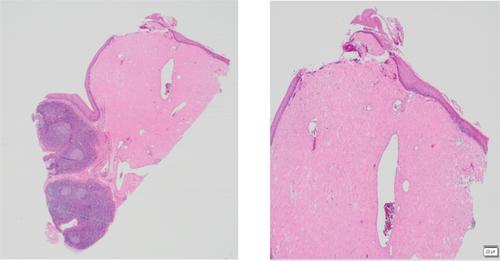 Localized Amyloidosis of the Oral Cavity: A Rare Clinical Entity