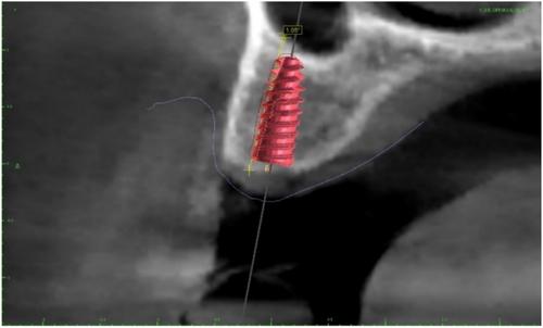Positional Accuracy of Dental Implants Placed by Means of Fully Guided Technique in Partially Edentulous Patients: A Retrospective Study