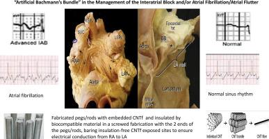 Carbon nanotube fibers to restore interatrial conduction in patients for prevention/management of atrial fibrillation