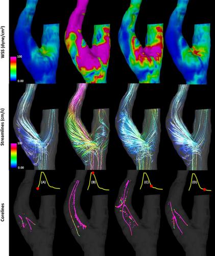 Modeling Hemodynamic Effects of the Closure Procedure of Carotid Artery Endarterectomy
