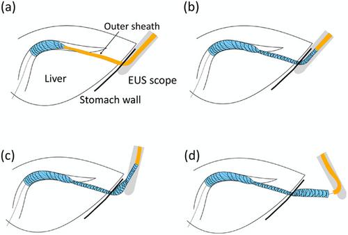 Prevention of Adverse Events in Endoscopic Ultrasound-Guided Biliary Drainage