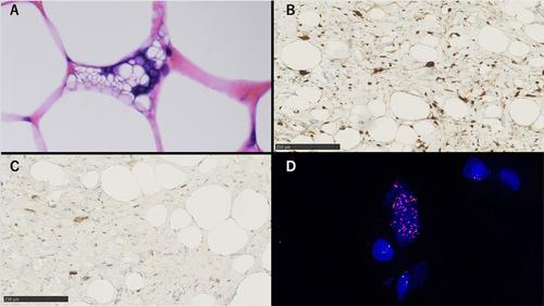 A Case of Gastric Atypical Lipomatous Tumor/Well-Differentiated Liposarcoma With Endoscopic Morphological Changes