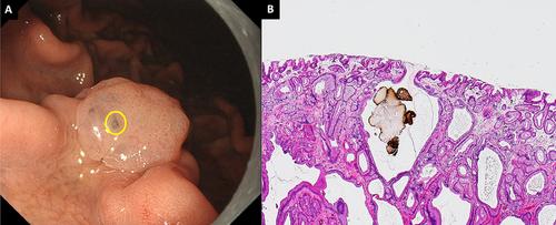 Visibility Evaluation of Fundic Gland Polyp Associated With Proton Pump Inhibitor in Texture and Color Enhancement Imaging