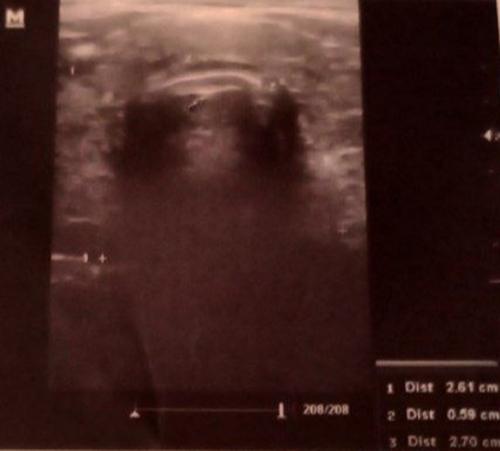 The Challenging Management of Rheumatoid Arthritis Overlapping With Graves' Disease in a Young Male: A Case Report
