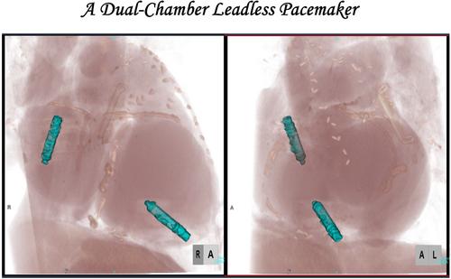 Opening the door to a new era: A dual-chamber leadless pacemaker