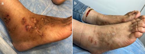Effective Treatment of Livedoid Vasculopathy With Oral Tofacitinib