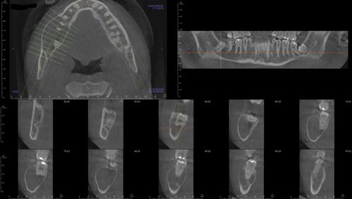 Diagnosis and Treatment of Idiopathic Bone Cavity in the Mandible: A Case Report