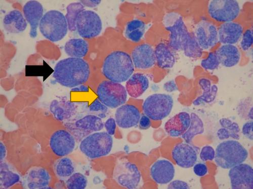 FIP1L1-PDGFRA Positive Chronic Eosinophilic Leukemia Presenting With Vestibular Neuritis
