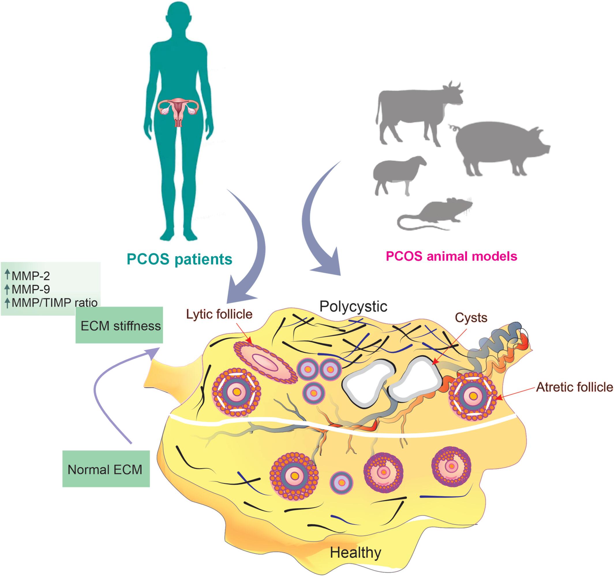 The Potential Role of Matrix Metalloproteinase in Polycystic Ovary Syndrome: Implications for Extracellular Matrix Remodeling