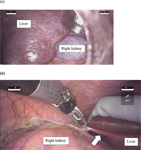 Robot-Assisted Laparoscopic Radical Nephrectomy in a Renal Cell Carcinoma Patient With Severe Scoliosis: A Case Report