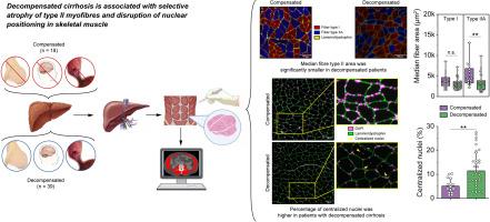Type II fibre atrophy and nuclear disruption in decompensated cirrhosis