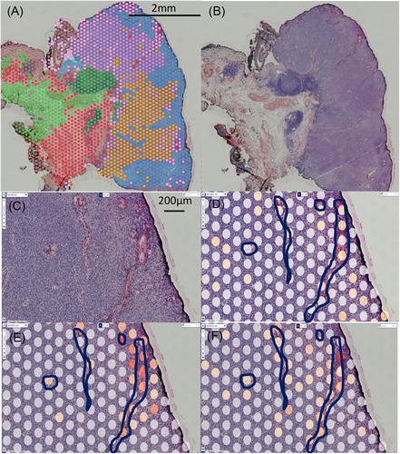 Ligand-Receptor Interactions Between Squamous and Endothelial Cells Induce Head and Neck Squamous Cell Carcinoma