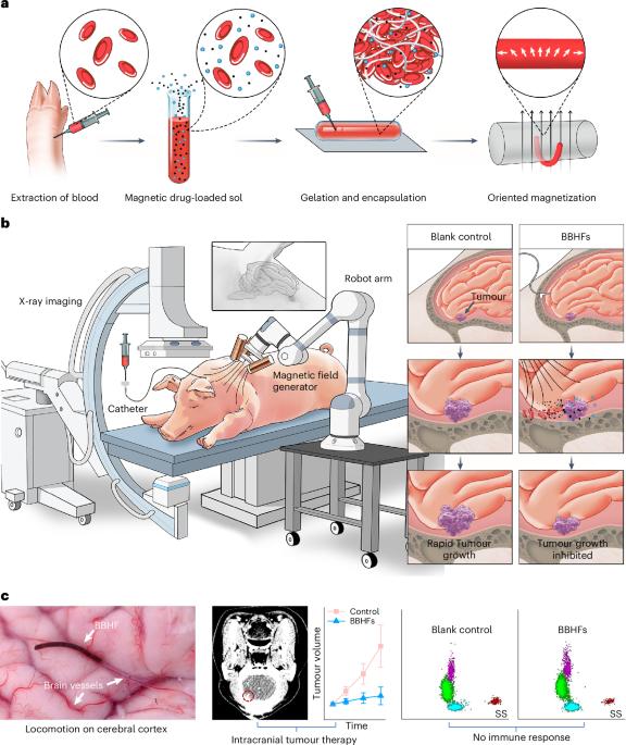 Magnetically driven biohybrid blood hydrogel fibres for personalized intracranial tumour therapy under fluoroscopic tracking