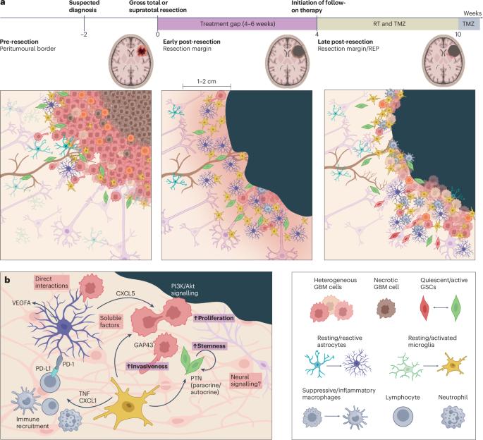 Targeting the glioblastoma resection margin with locoregional nanotechnologies