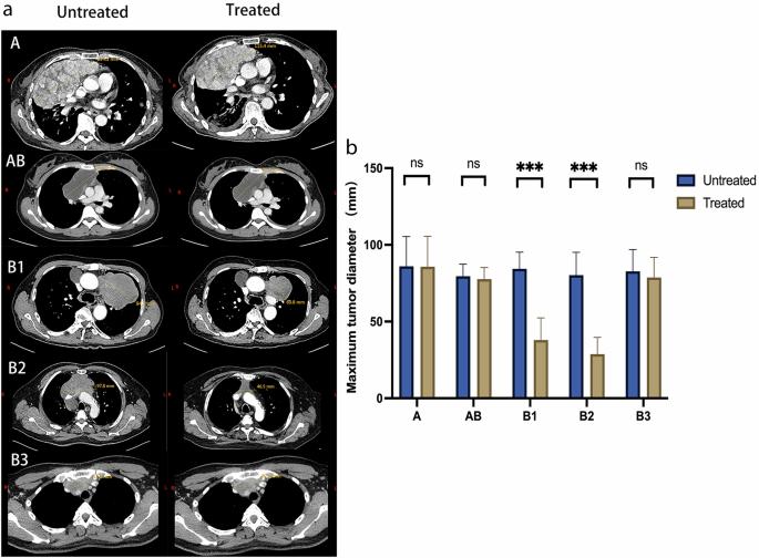 Novel modulation of T effector memory cells-expressing CD45RA by prednisone in inoperable advanced type B thymoma patients