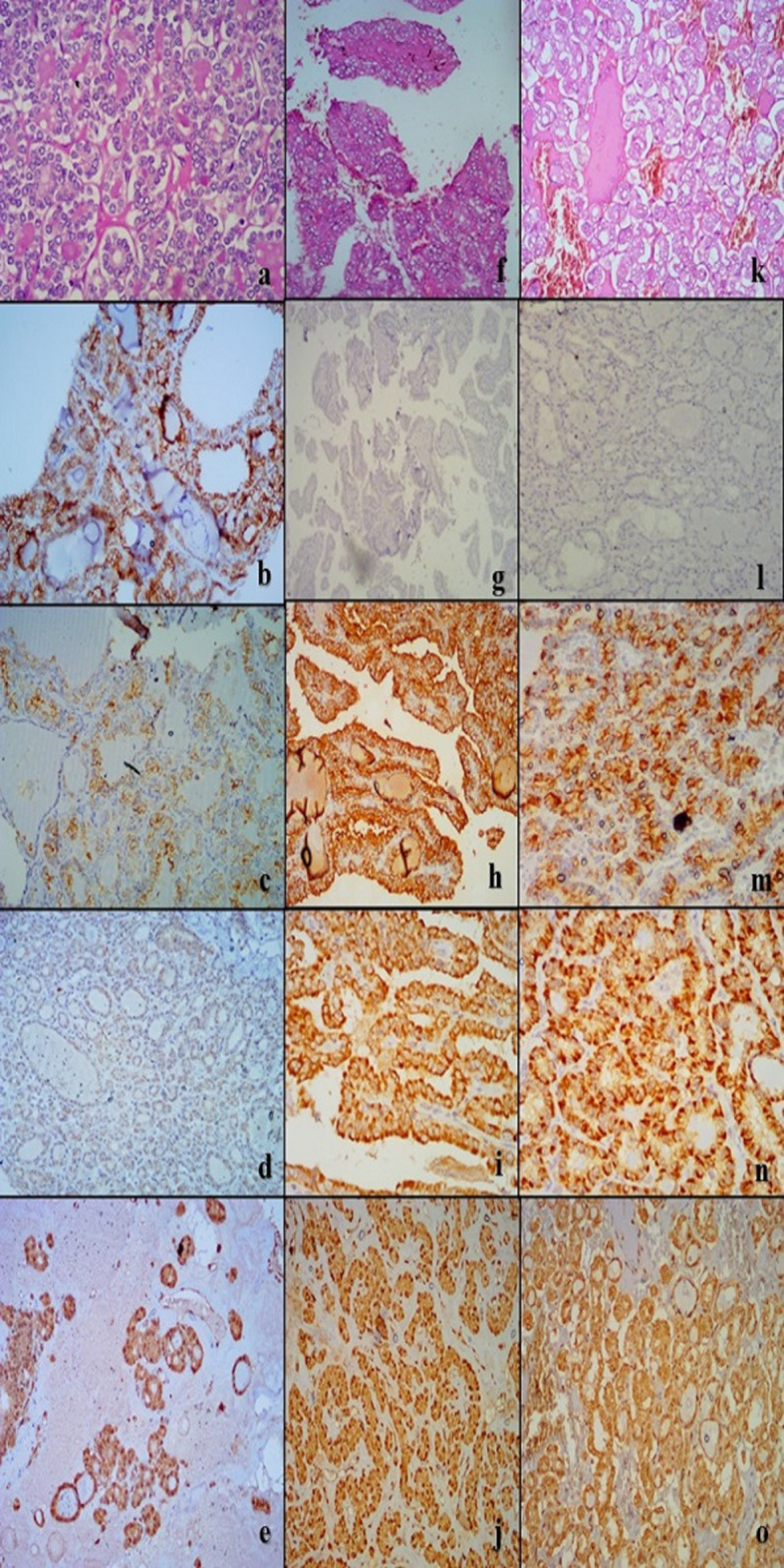 Immunohistochemical profile of non-invasive follicular thyroid neoplasm with papillary-like nuclear features (NIFTP) versus other thyroid follicular lesions.