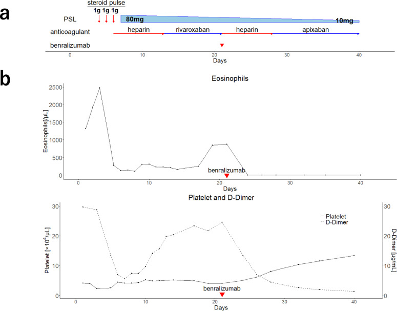 Benralizumab for acute thromboembolism in hypereosinophilic syndrome: a case report.