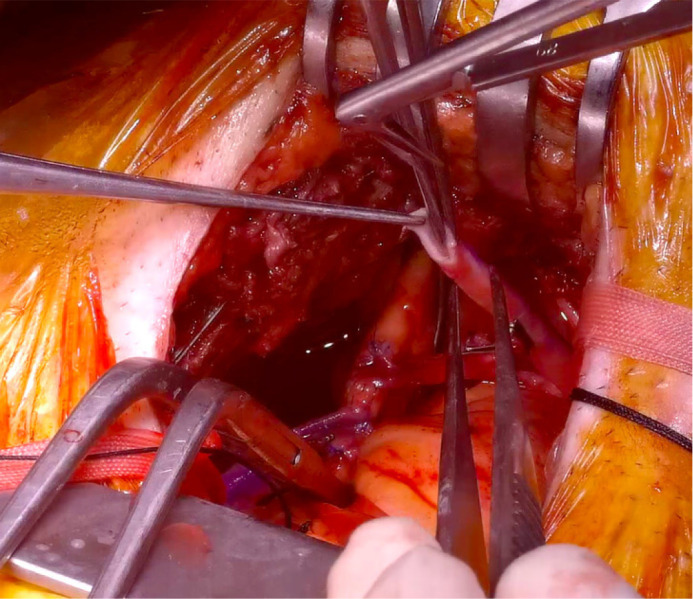 Left Anterior Mini-Thoracotomy vs. Conventional Sternotomy in On-Pump Multivessel Coronary Revascularization.