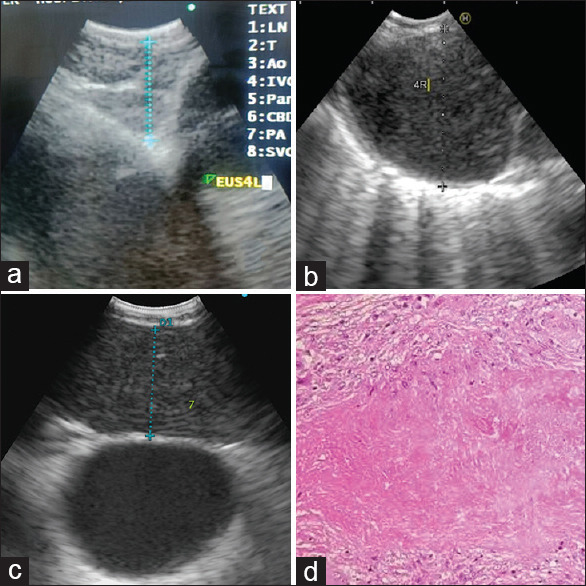 Pediatric mediastinal tuberculosis: Exploring the diagnostic precision of endobronchial ultrasound and ancillary investigations.