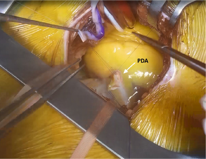 Left Anterior Mini-Thoracotomy vs. Conventional Sternotomy in On-Pump Multivessel Coronary Revascularization.