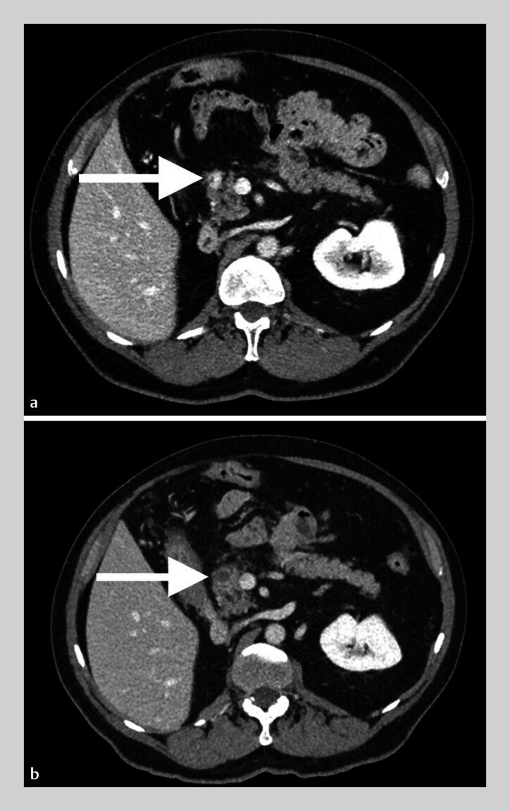 Effectiveness and safety of endoscopic ultrasound-guided radiofrequency ablation for pancreatic metastases of renal cell carcinoma.