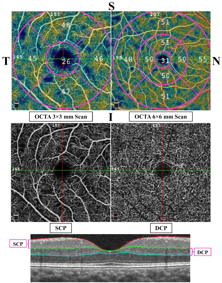 Macular thickness and vascular density assessment using optical coherence tomography and optical coherence tomography angiography imaging in iron ore mine personnel.