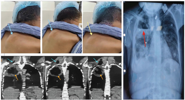Bronchocutaneous Fistula Secondary to Tuberculosis