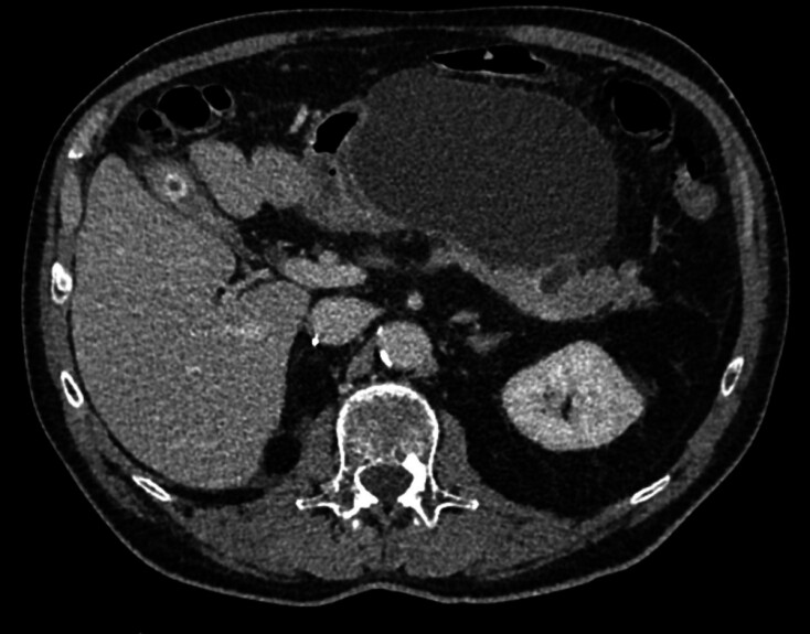 Effectiveness and safety of endoscopic ultrasound-guided radiofrequency ablation for pancreatic metastases of renal cell carcinoma.