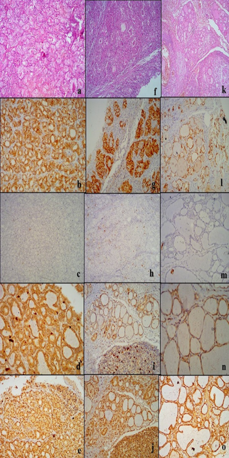 Immunohistochemical profile of non-invasive follicular thyroid neoplasm with papillary-like nuclear features (NIFTP) versus other thyroid follicular lesions.