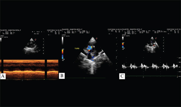 Peritoneo pericardial hernioplasty in a 2-month-old Shih Tzu.
