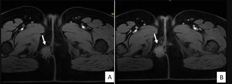 Perineal endometriosis on an episiotomy scar: diagnosis based on clinical, radiological, and hormonal criteria (case report).