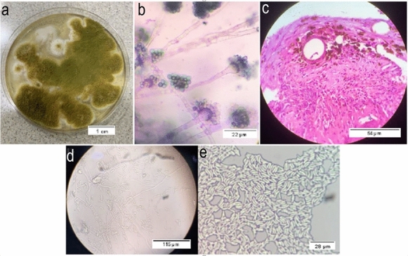 Emergent Aspergillus tamarii and Fusarium falciforme Keratitis.