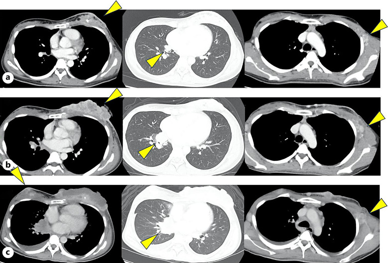 Entrectinib-Induced Pericarditis with Cardiac Tamponade in a Patient with Neurotrophic Tropomyosin Receptor Kinase 1 Fusion-Positive Breast Cancer.