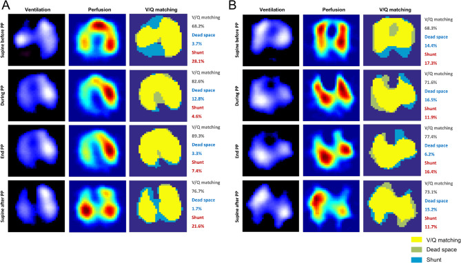 Association between ventilation-perfusion matching improvement during initial prone positioning and ICU mortality in patients with moderate to severe ARDS: a prospective two-center study.