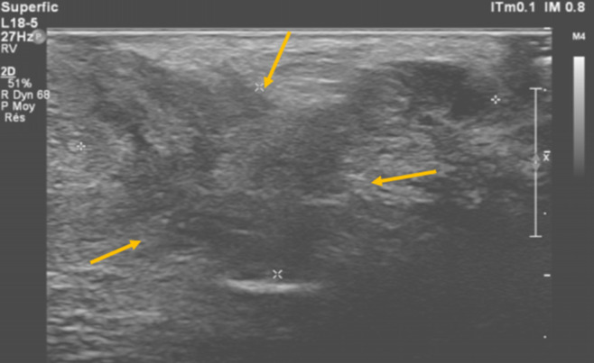 Perineal endometriosis on an episiotomy scar: diagnosis based on clinical, radiological, and hormonal criteria (case report).