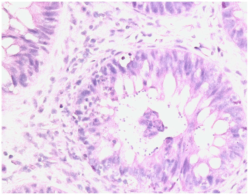 Fecal Microbiota Transplantation as a Salvage Therapy for Concomitant Resistant Digestive Graft Versus Host Disease and Cryptosporidiosis in a Patient Post Hematopoietic Stem Cell Transplant: about a Case.