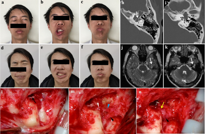 Outcome of different facial nerve managements in petrous bone cholesteatoma patients with facial paralysis.