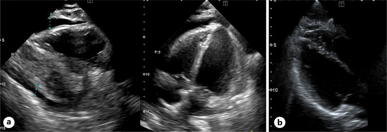 Entrectinib-Induced Pericarditis with Cardiac Tamponade in a Patient with Neurotrophic Tropomyosin Receptor Kinase 1 Fusion-Positive Breast Cancer.