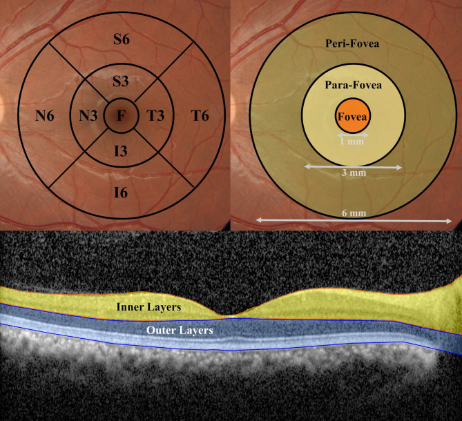 Macular thickness and vascular density assessment using optical coherence tomography and optical coherence tomography angiography imaging in iron ore mine personnel.