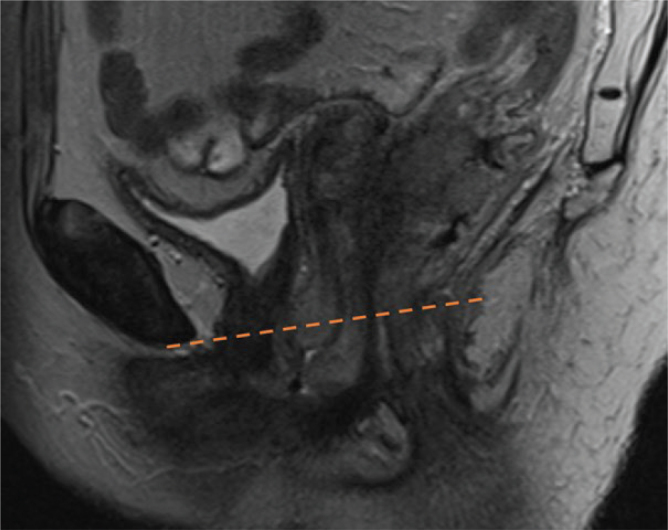 Impact of the risk-adapted Nordic anal cancer group consensus guidelines on the contouring of the elective clinical target volume in anal cancer.