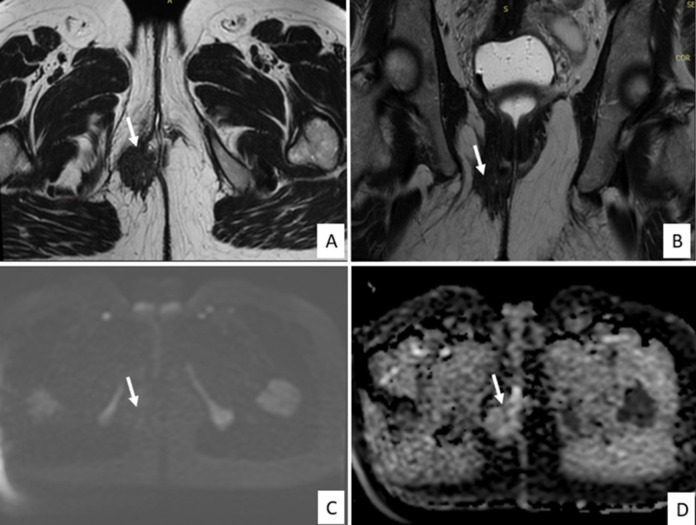 Perineal endometriosis on an episiotomy scar: diagnosis based on clinical, radiological, and hormonal criteria (case report).