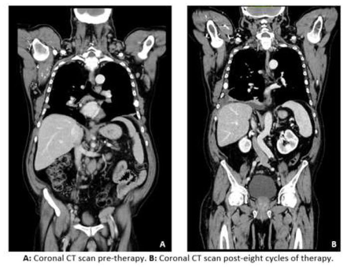 A Case of Multiple Myeloma in a Patient in Treatment for Chronic Lymphocytic Leukemia.
