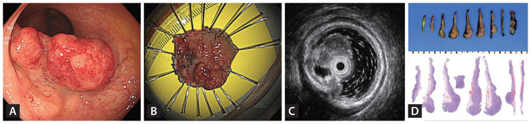 Unusual polypoid mass in the colon.