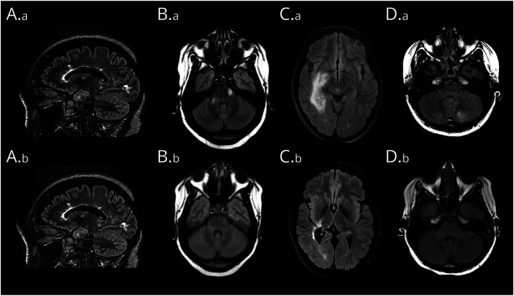 Abnormal Brain MRI in Anti-NMDA Receptor Encephalitis: Clinical and Prognostic Implications.